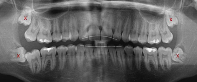 Impacted-Wisdom-Teeth-X-ray
