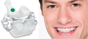 Ceramic Braces, braces, Traditional Ceramic Braces