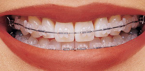 Ceramic Braces, braces, Traditional Ceramic Braces