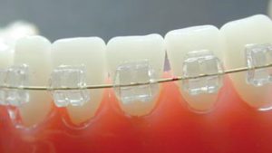 Ceramic Braces, braces, Traditional Ceramic Braces