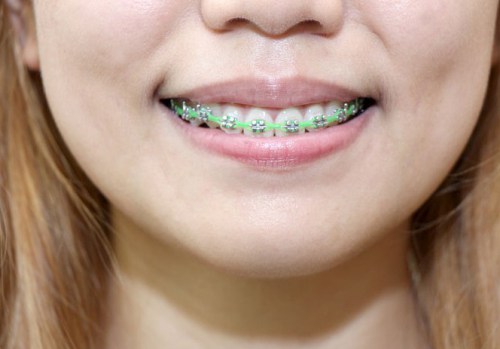 670px-Clean-Teeth-With-Braces-Step-11