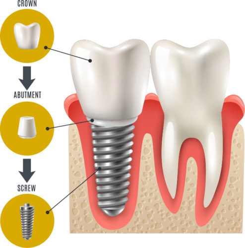 dental implants