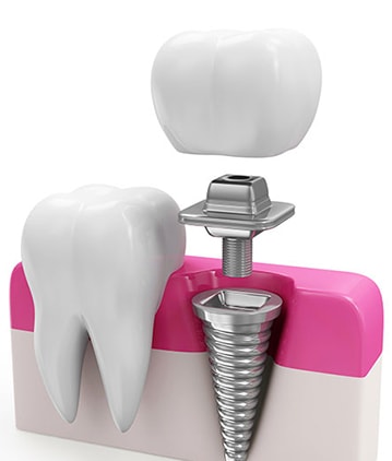 dental implants, implants,