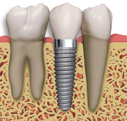 barrington-implant-between-2-teeth