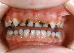 tooth-decay-baby-teeth